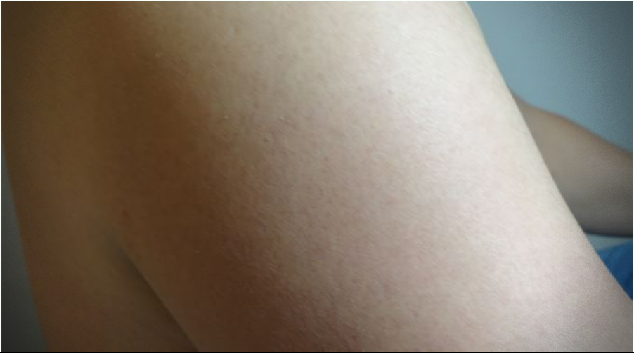 안양모공각화증 치료 후