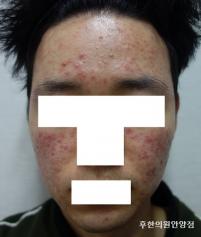 안영여드름피부병원 치료 전