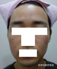 안양여드름피부병원 치료 후