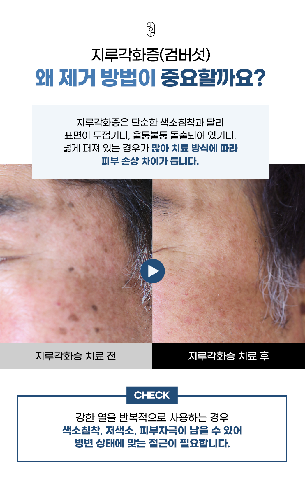 지루각화증 제거 방법에 따른 피부 손상 차이, 치료 전후 비교