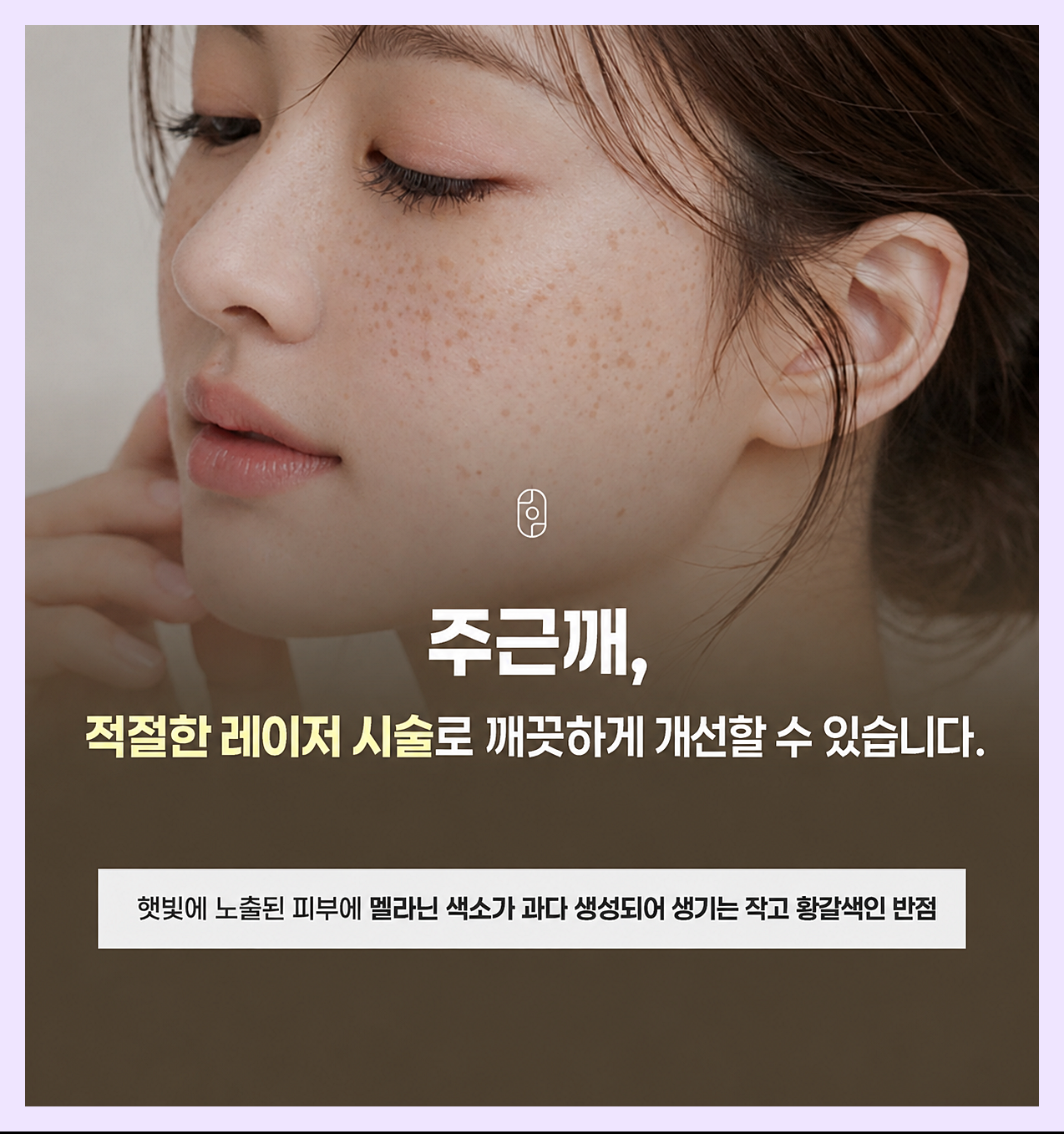 안양주근깨레이저 주근깨의 정의에 대한 이미지