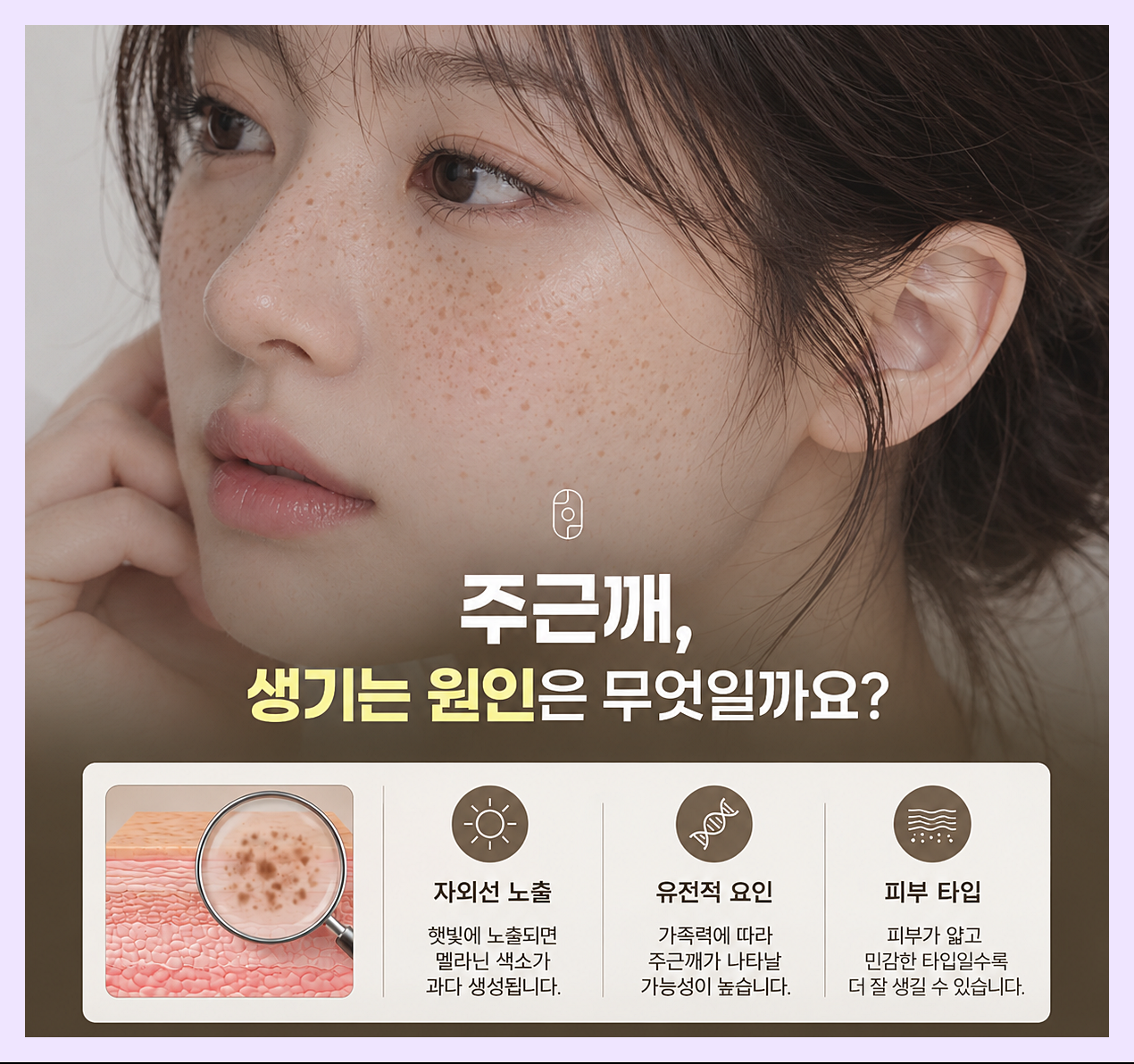 주근깨의 다양한 원인을 설명하는 이미지
