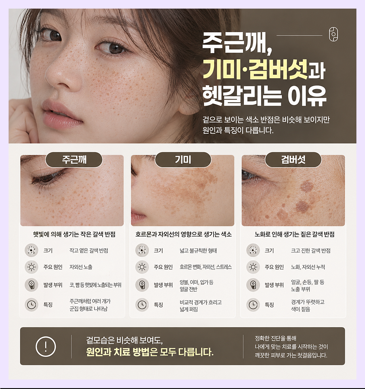 주근깨와 기미 검버섯의 차이를 정리한 이미지