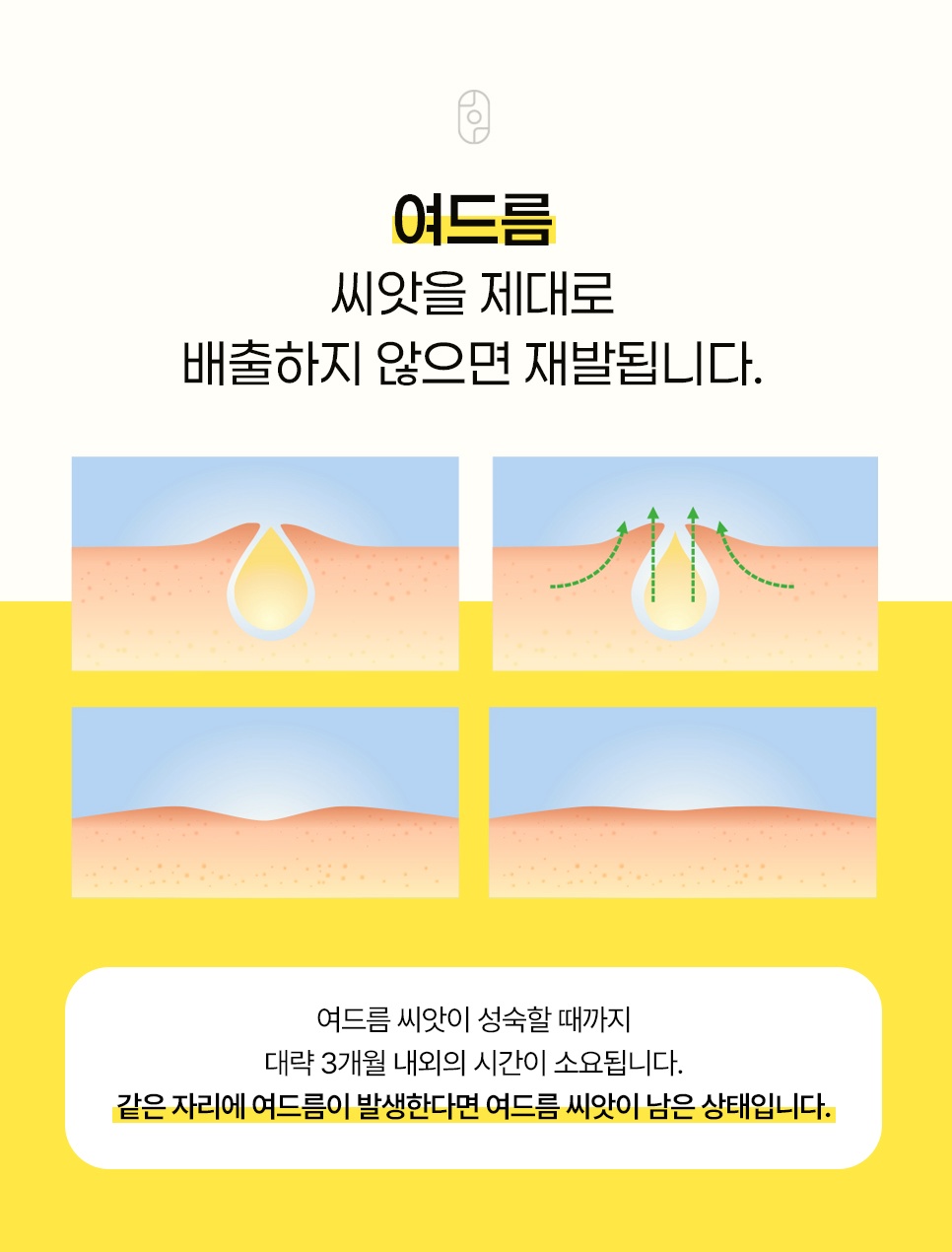 여드름 씨앗 미배출 시 재발 원리 설명