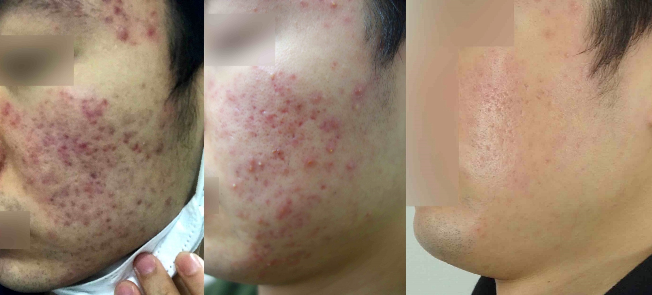 여드름 압출 치료 전후 붉어진 피부 비교 사진