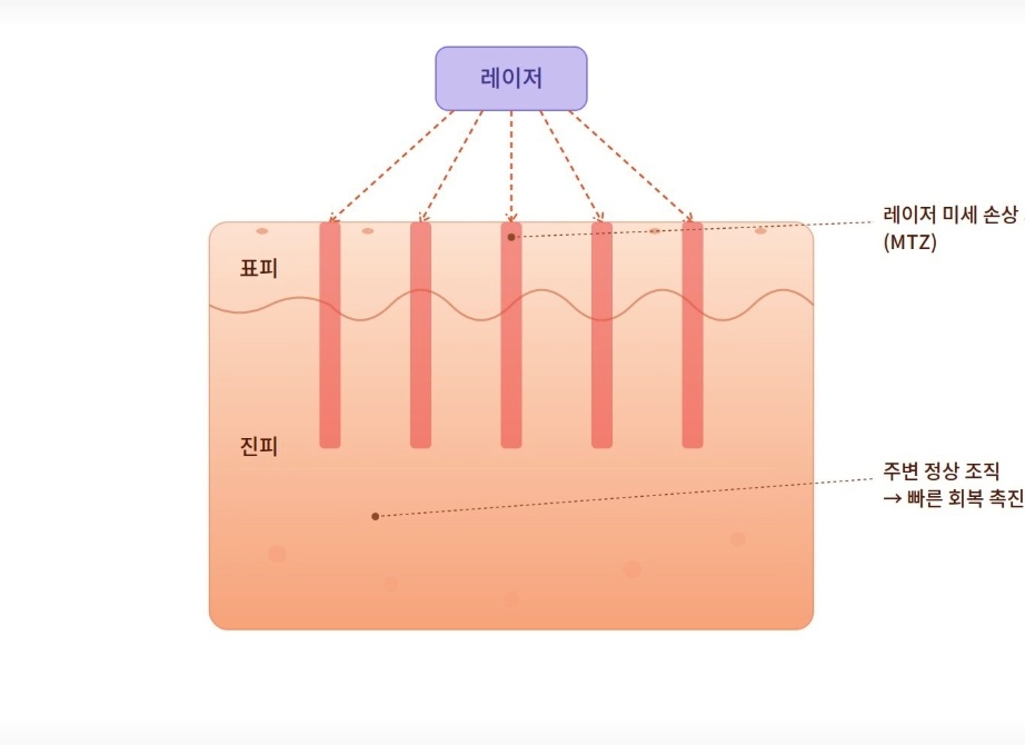 레이저 시술 시 표피와 진피에 미세 손상을 주는 원리 도식