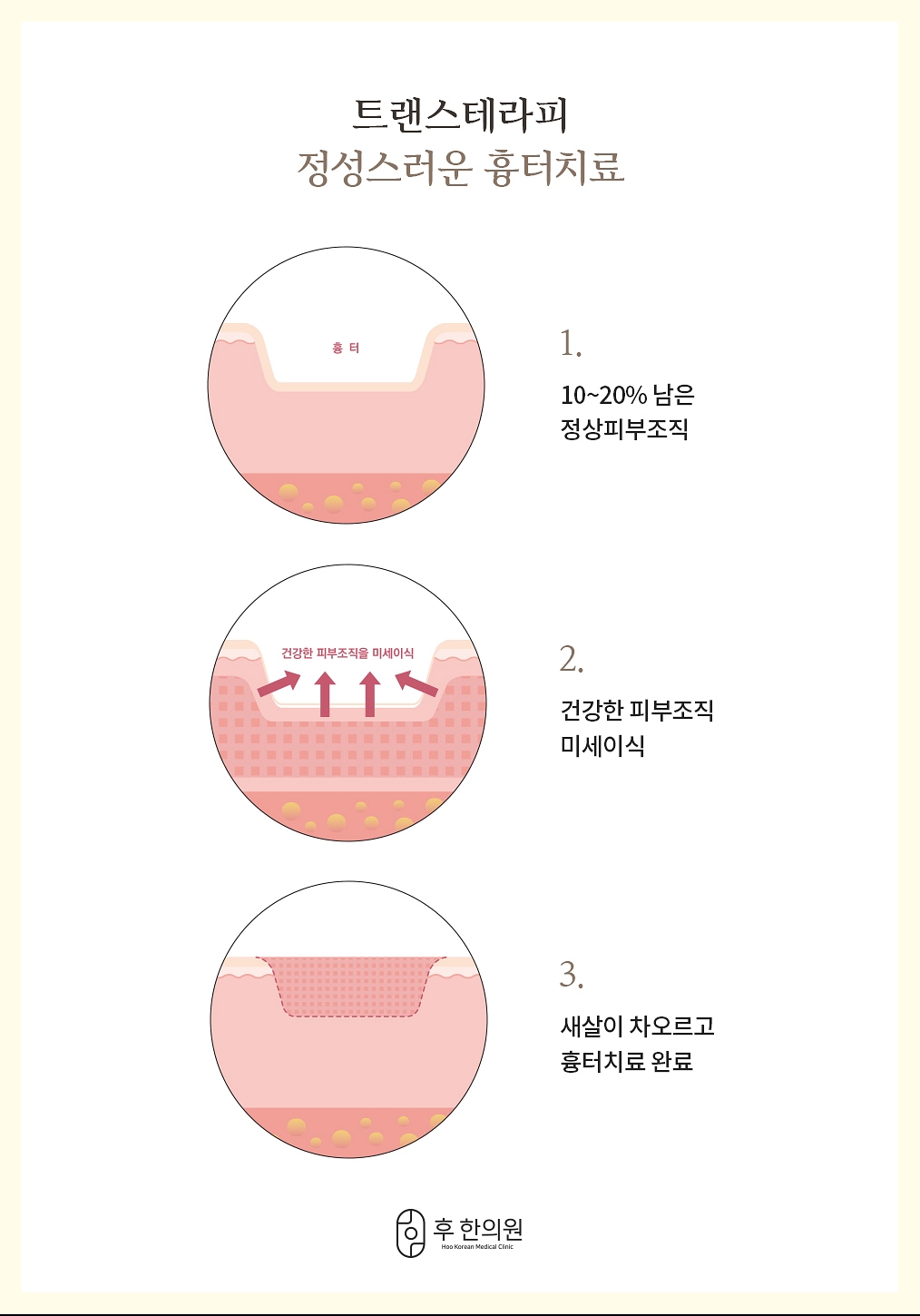 안양새살침 트랜스테라피의 흉터 치료 원리를 설명하는 내용