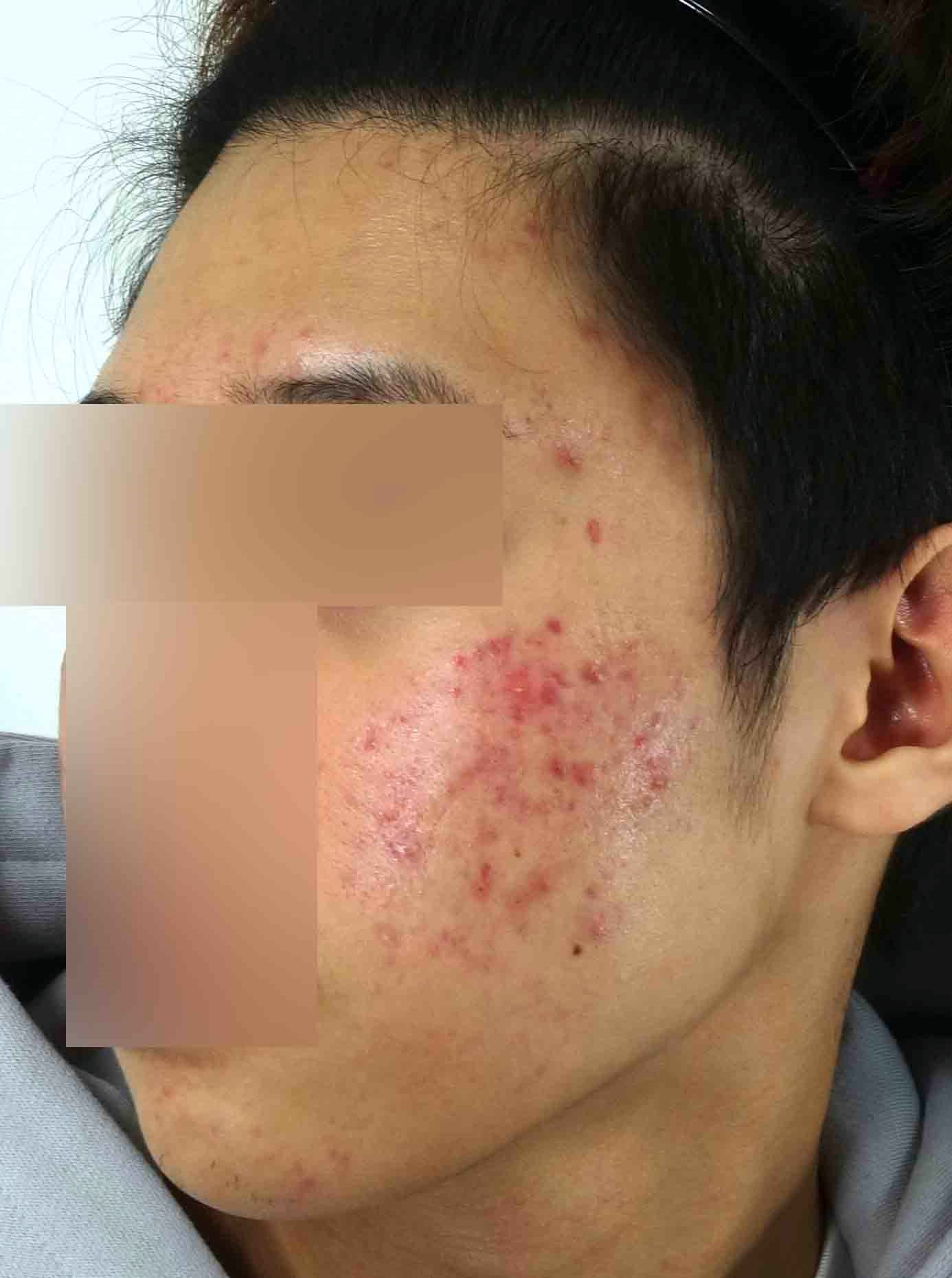 여드름 치료 전 볼 및 턱 부위 화농성 여드름 피부 상태