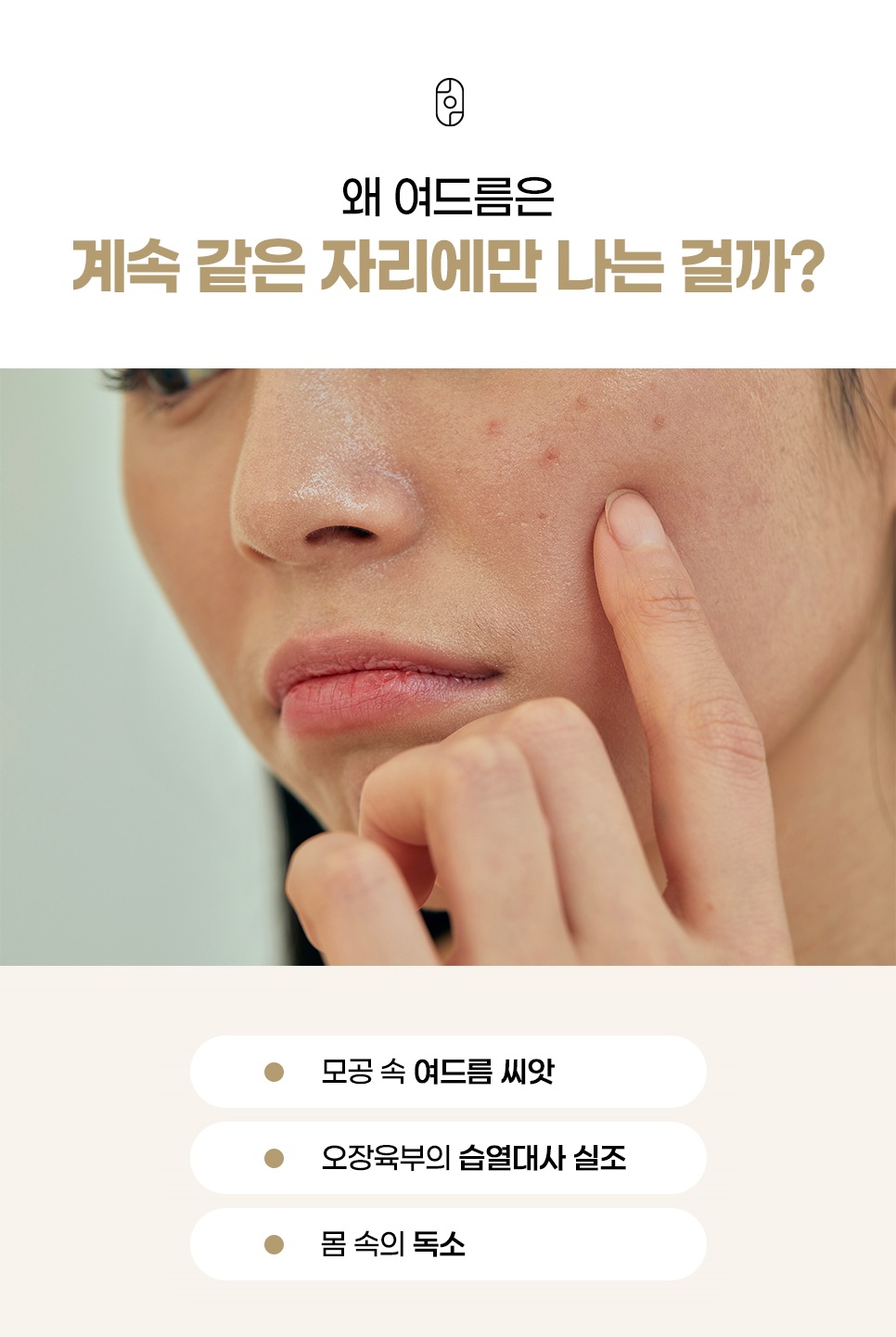 반복되는 여드름 원인 3가지
