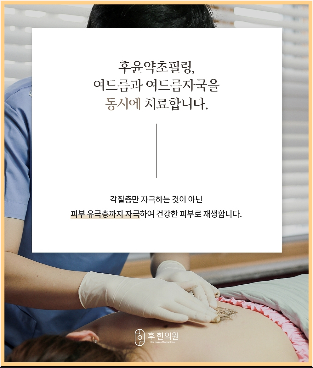 여드름과 여드름자국에 모두 도움을 주는 약초필링 특징 이미지