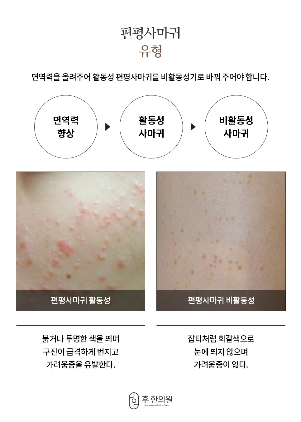 붉게 번지는 활동성과 회갈색 점 모양 비활동성 편평사마귀 유형 구분