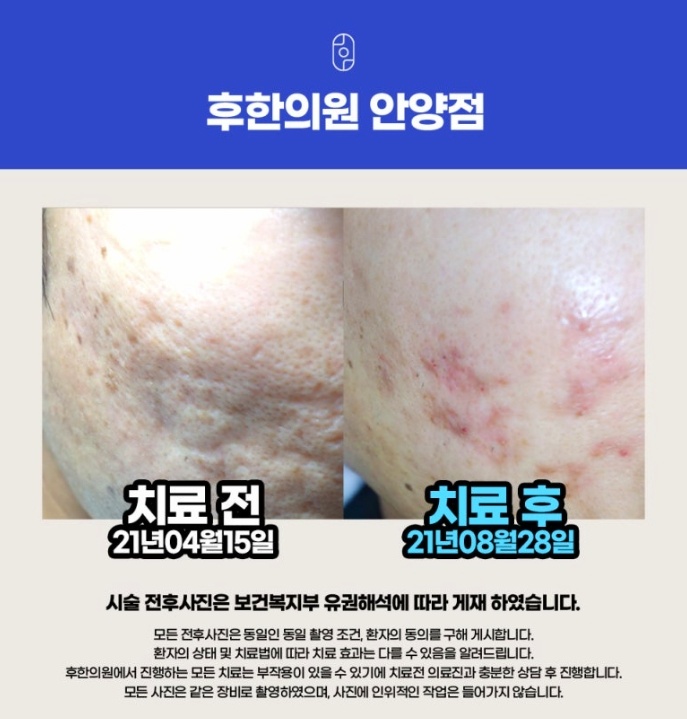 후한의원 안양점 여드름 흉터 치료 전후 비교 사진