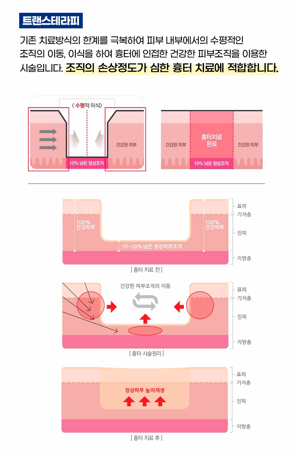 트랜스테라피 수평 조직 이식 및 새살 재생 원리