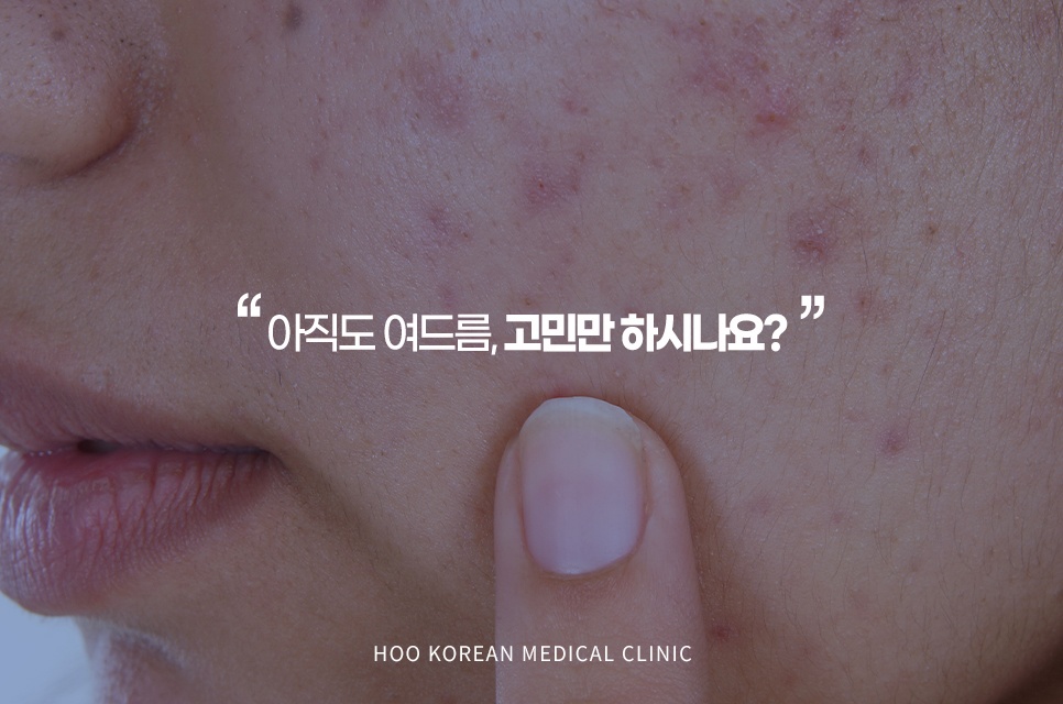 반복되는 성인 여드름 피부 고민과 원인 분석