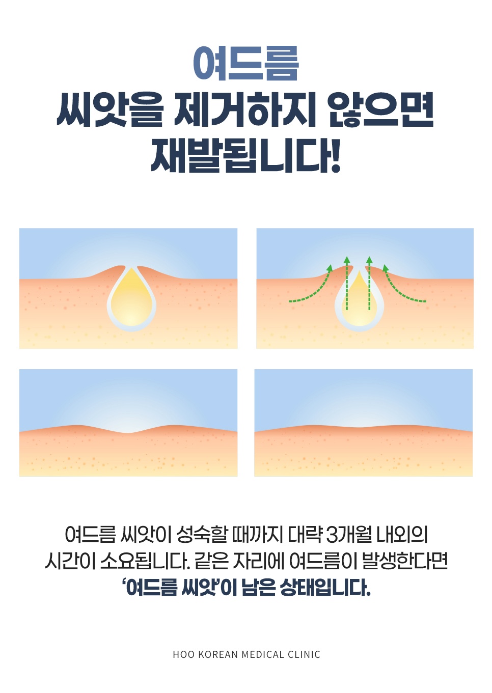 재발 없는 여드름 치료를 위한 모공 속 여드름 씨앗(피지선) 제거 중요성