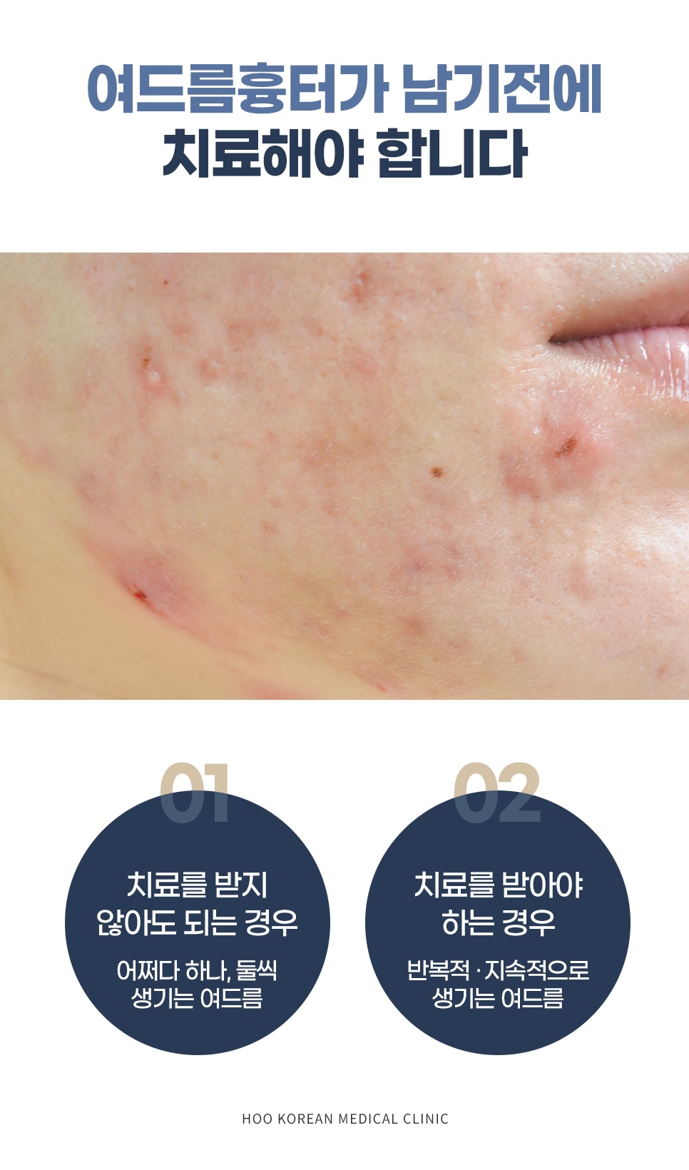 패인 여드름 흉터 예방을 위한 단계별 여드름 치료 필요성