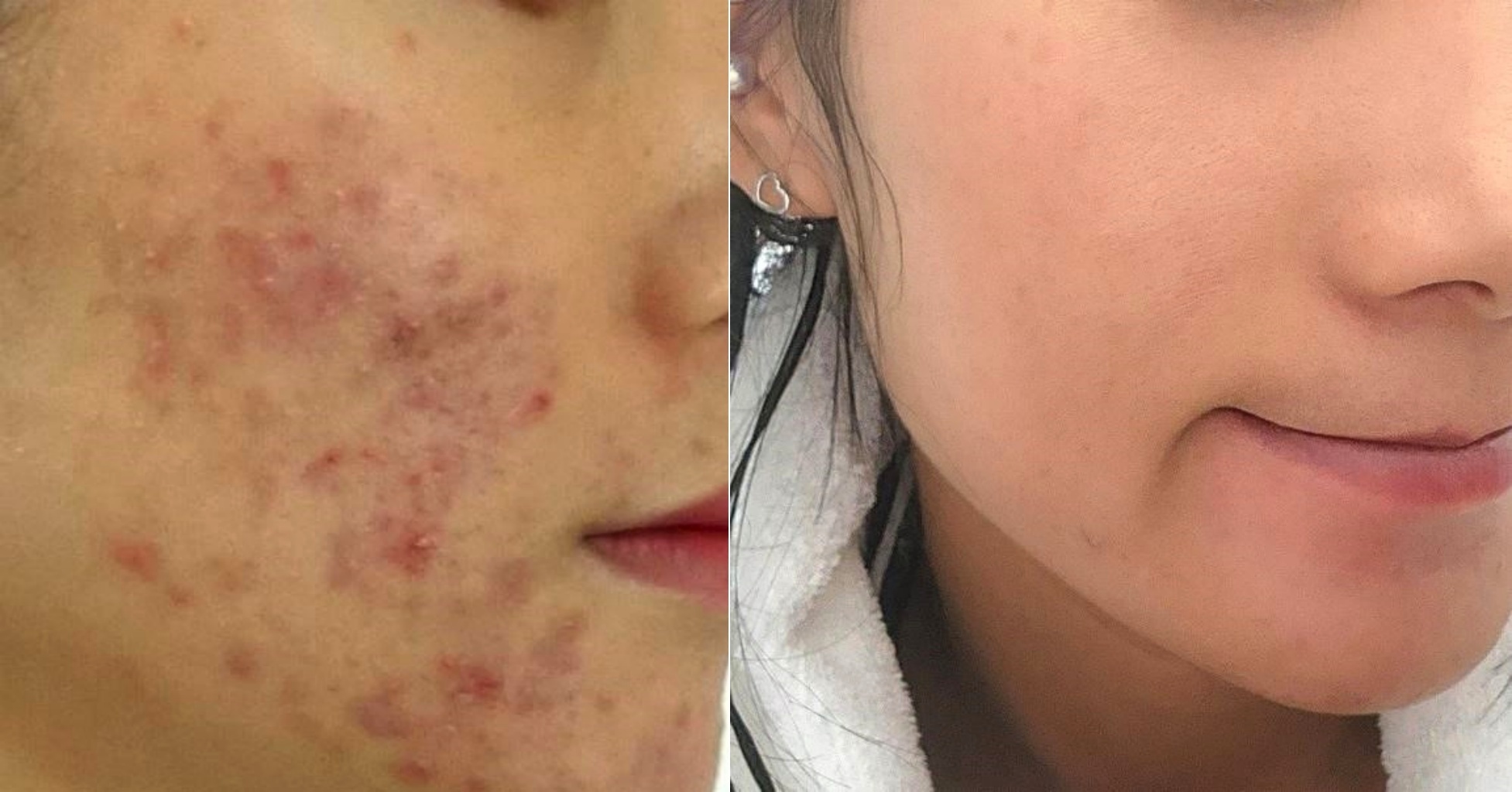 붉은 염증이 퍼진 볼이 매끈하게 정돈된 여드름 치료 전후 클로즈업