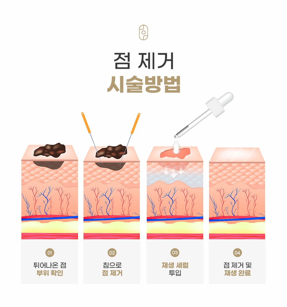 튀어나온 점을 침으로 제거하고 재생세럼으로 마무리하는 4단계 단면도