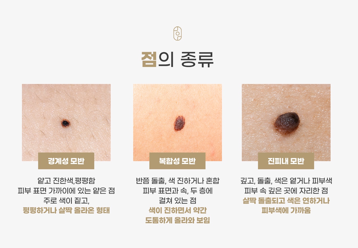 경계성·복합성·진피내 모반으로 나눈 점의 종류별 특징