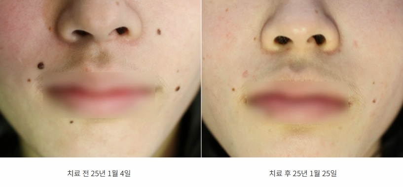 코 옆과 입가에 흩어진 점이 옅어진 25년 1월 전후 비교