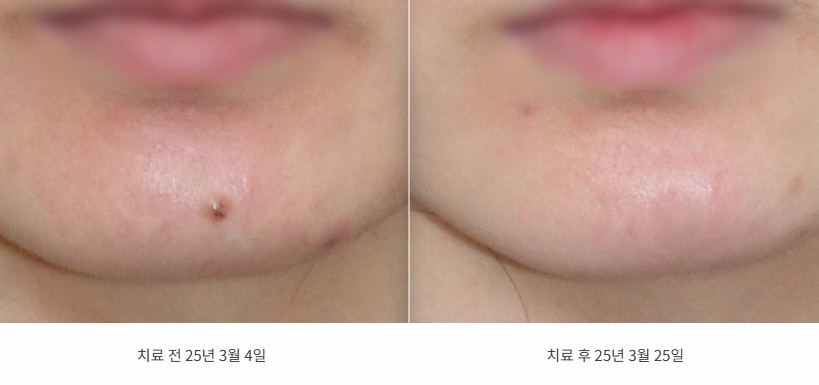아랫입술 아래 턱 점이 사라진 25년 3월 전후 비교