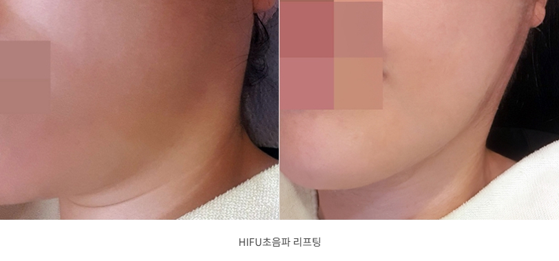 턱선과 볼 라인이 또렷해진 HIFU 초음파 리프팅 전후 비교