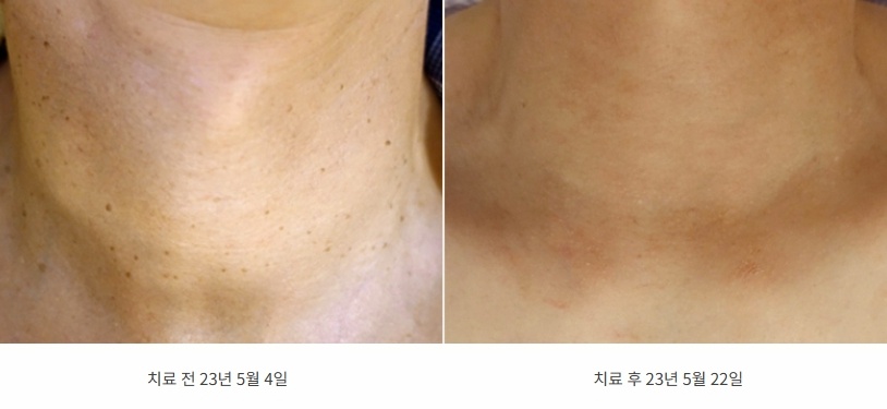 목 앞쪽에 점처럼 퍼진 편평사마귀가 옅어진 23년 5월 전후 사진