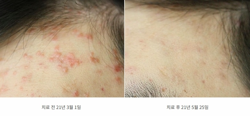 이마 헤어라인에 붉게 올라온 편평사마귀가 가라앉은 21년 3월과 5월 전후 비교