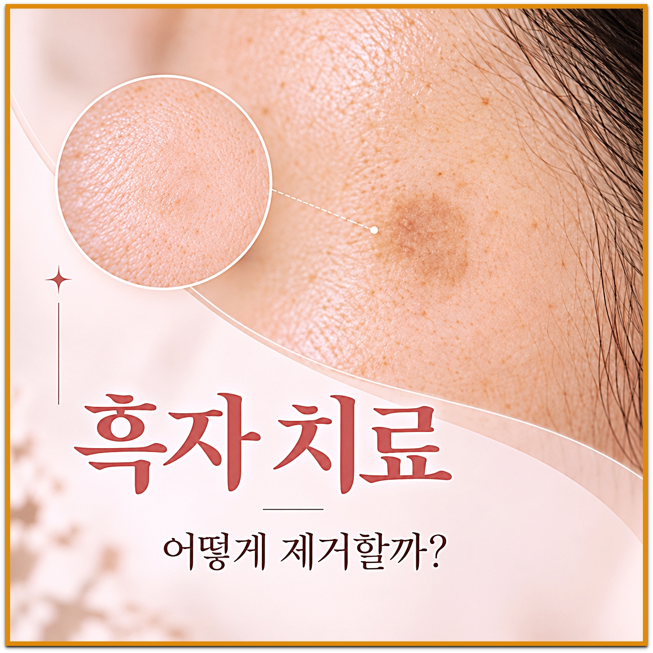 안양흑자제거 흑자 치료 어떻게 제거할까 안내 이미지