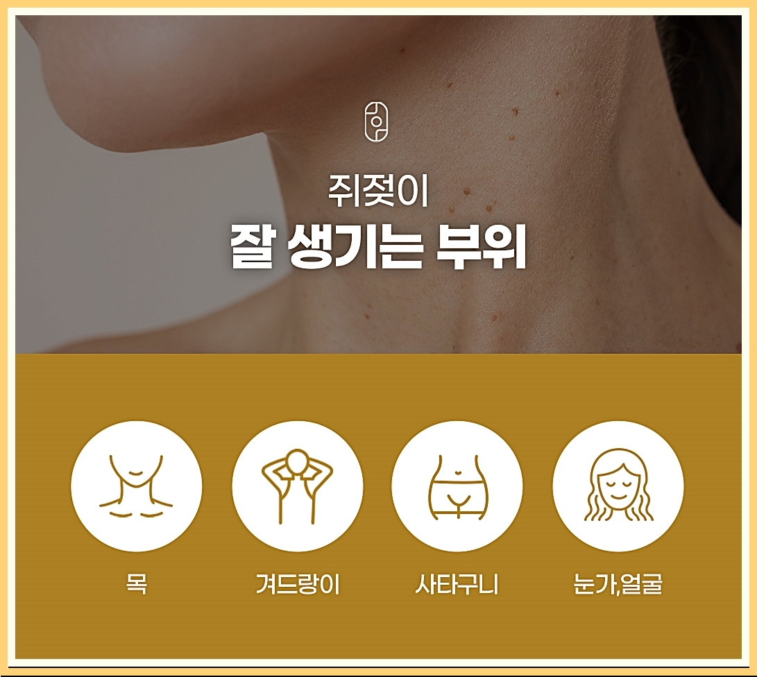 안양쥐젖 쥐젖이 잘 생기는 부위 이미지