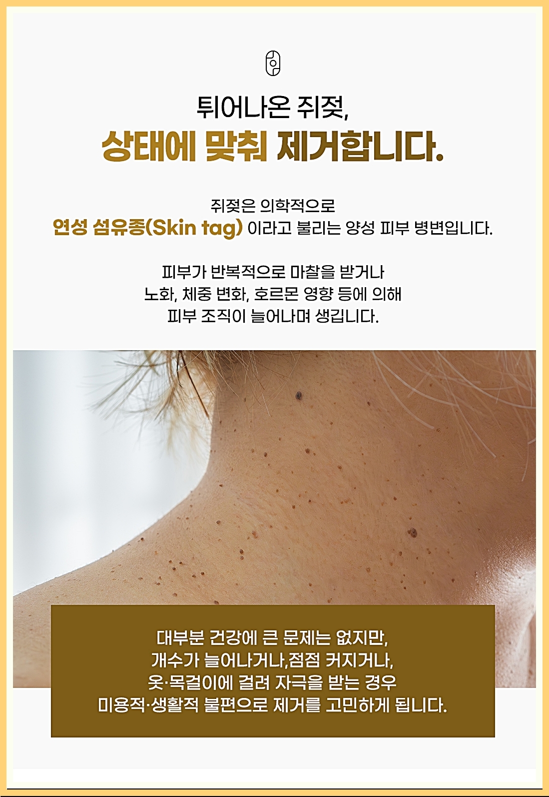 안양쥐젖 상태에 맞는 제거의 중요성