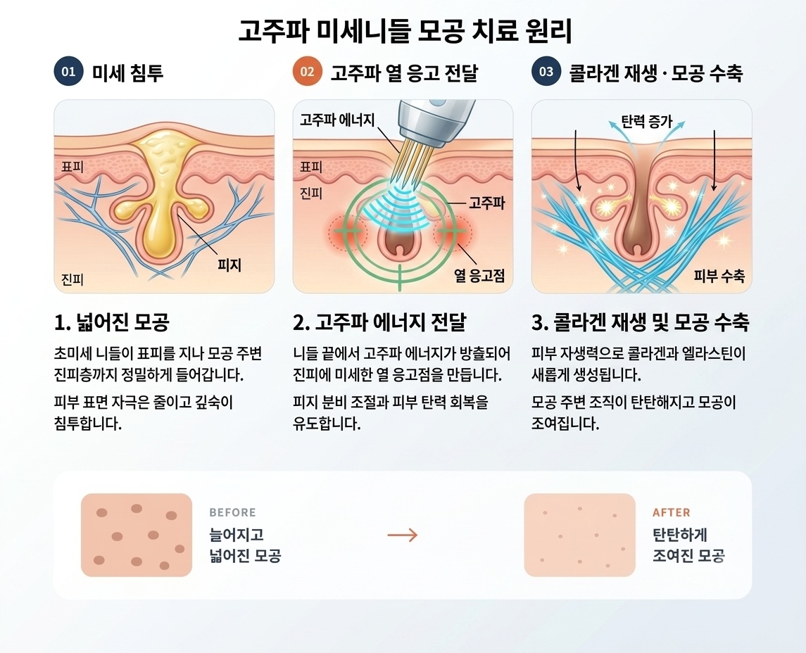 초미세 니들이 모공 주변 진피까지 들어가 고주파 열 응고를 만들고 콜라겐 재생과 모공 수축을 돕는 3단계 도해