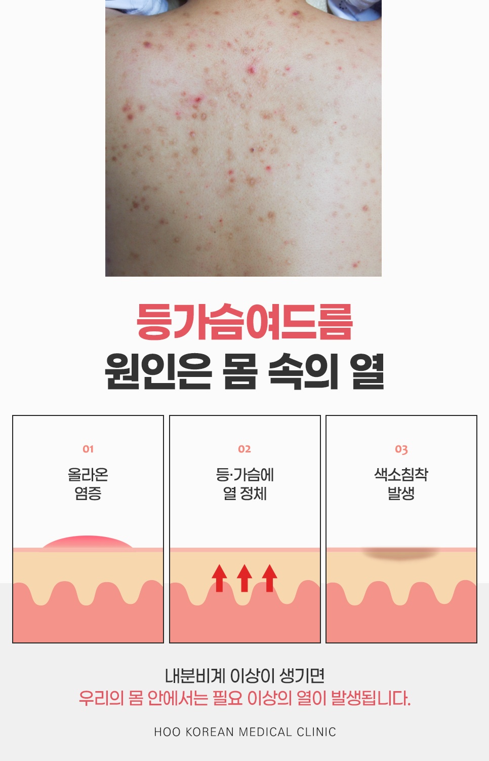 올라온 염증과 등·가슴에 쌓인 열, 색소침착으로 이어지는 등가슴여드름의 원인이 몸속 열이라는 3단계