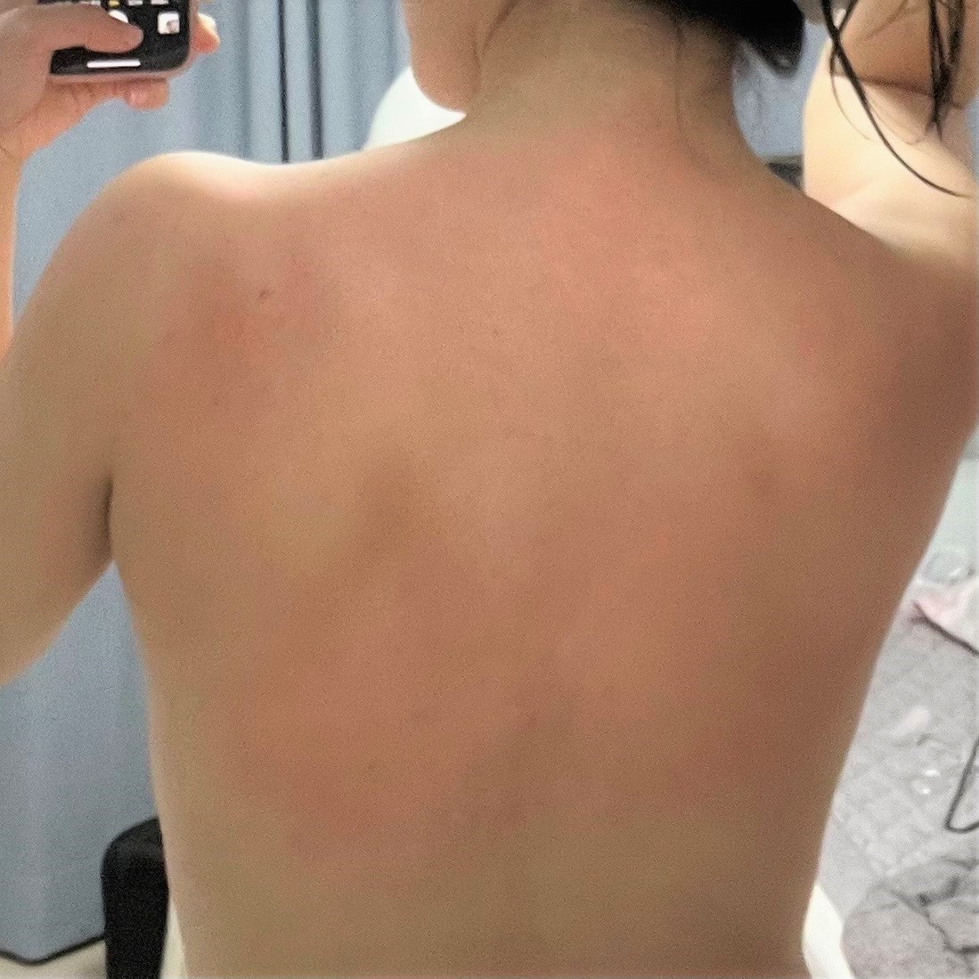 등여드름과 자국 치료 후